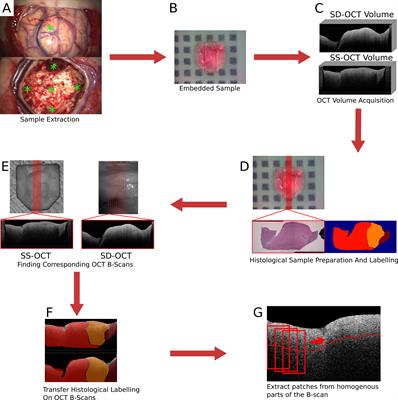 Differentiation of different stages of brain tumor infiltration using optical coherence tomography: Comparison of two systems and histology